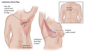 Breast Reconstruction in Turkey