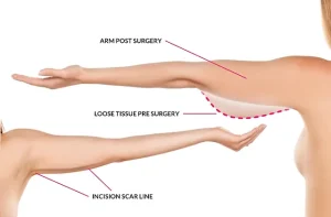 Brachioplasty