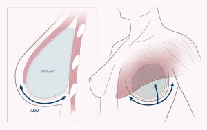 Breast Reconstruction