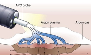 Argon Plasma Liposuction in Turkey