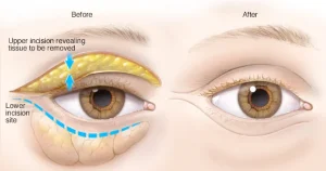 Eyelid Surgery (Blepharoplasty)