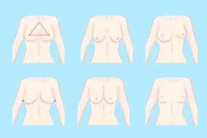 Breast Asymmetry Correction