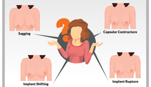 Breast Implant Revision