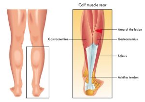 Calf Aesthetics Surgery