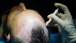 DHI Hair Transplant