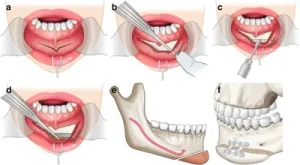 Chin Implants