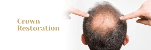 Crown Hair Transplant