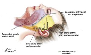 Deep Plane Facelift Recovery