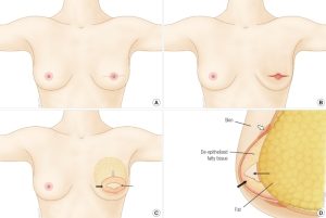 Nipple Areola Reconstruction Surgery