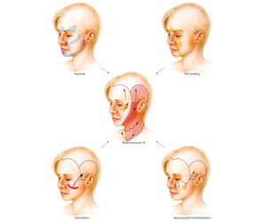 Endoscopic Facelift Surgery