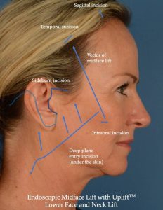 Endoscopic Midface Lift Techniques