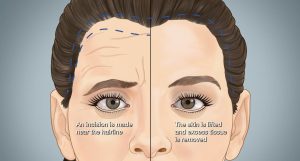 Eye Brow lift In Turkey