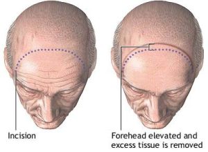 Forehead Lift Surgery