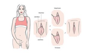 Female Genital Plastic Surgery 