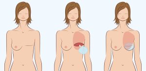 Breast Reconstruction