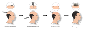 Grafts Extraction and Implantation