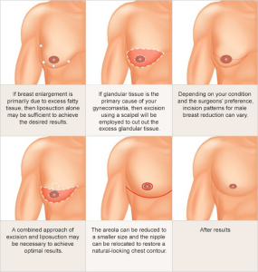 Gynecomastia Surgery