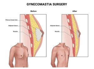 Gynecomastia Surgery