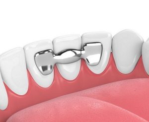 Hollywood Smile Procedure