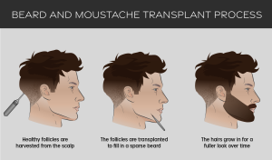 Wie wird die Barttransplantation durchgeführt?