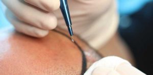 Channel Opening During Hair Transplant