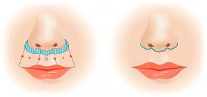 Lip Lift