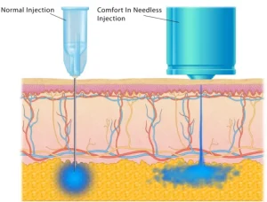 hair transplant procedure completely free of needles