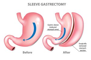 Obesity - Gastric Sleeve Surgery