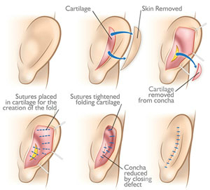 Otoplasty