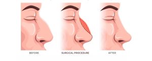 Chirurgie rhinoplastique