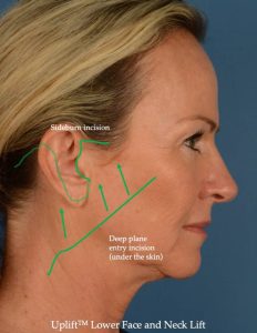 The Uplift Lower Face and Neck Lift