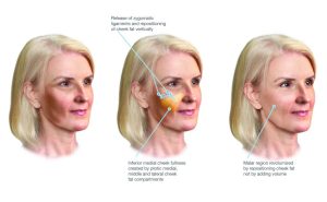 Traceless FaceliftTechnique