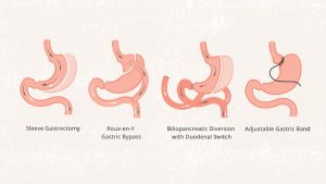 Obesity - Gastric Sleeve Surgery