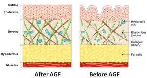 Hair Loss AGF Treatment In Turkey