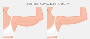 Arm Lift Surgery