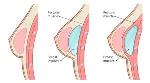 pose d'implants mammaires