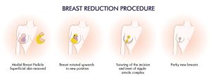 breast reduction surgery