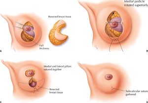 breast reduction surgery