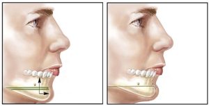 Chin augmentation Surgery