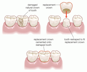 Dental Crowns in Turkey