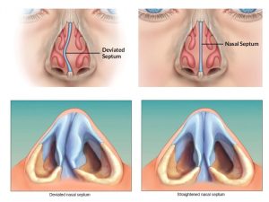 Septoplasty Surgery In Turkey