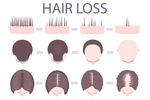 AGF-39 Hair Loss