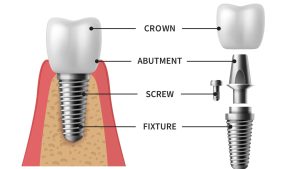 Dental Implants