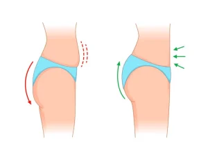 Brazilian Butt Lift (BBL) In Turkey