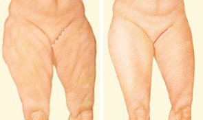 medial-thigh-lift-incision