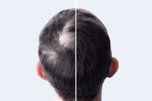 Crown Hair Transplant Before and after