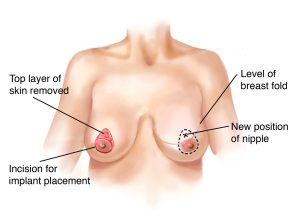 Nipple Areola Reconstruction Surgery