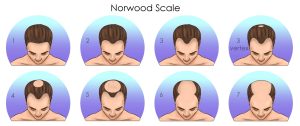 THE NORWOOD HAIR TRANSPLANT SCALE