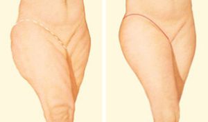 medial-thigh-lift-incision