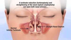 Septoplasty Surgery In Turkey